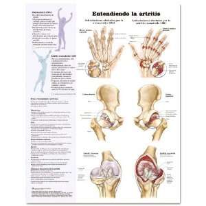 Arthritis Disease Chart SPANISH LANGUAGE  Industrial 