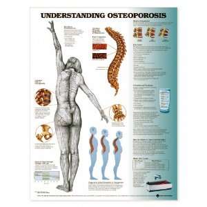 Understanding Osteoporosis Anatomical Chart Laminated, English (In 
